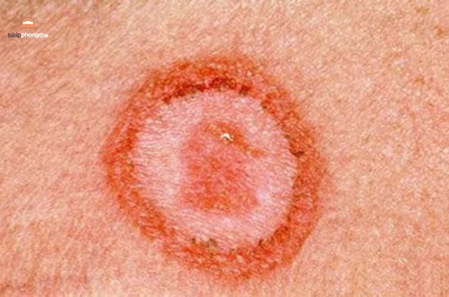 Bệnh hoa liễu là một thuật ngữ chung để chỉ các bệnh lây truyền qua đường tình dục (STIs)