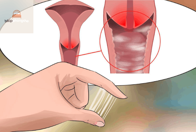 Có nhiều nguyên nhân dẫn đến hiện tượng ra dịch trắng trong sau quan hệ 1 ngày